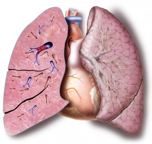 Florida Lung,Asthma and Sleep Specialists demonstrate the path of a lung blood clot 