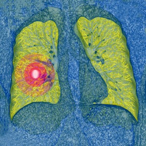 Lung Cancer Scans save lives. 