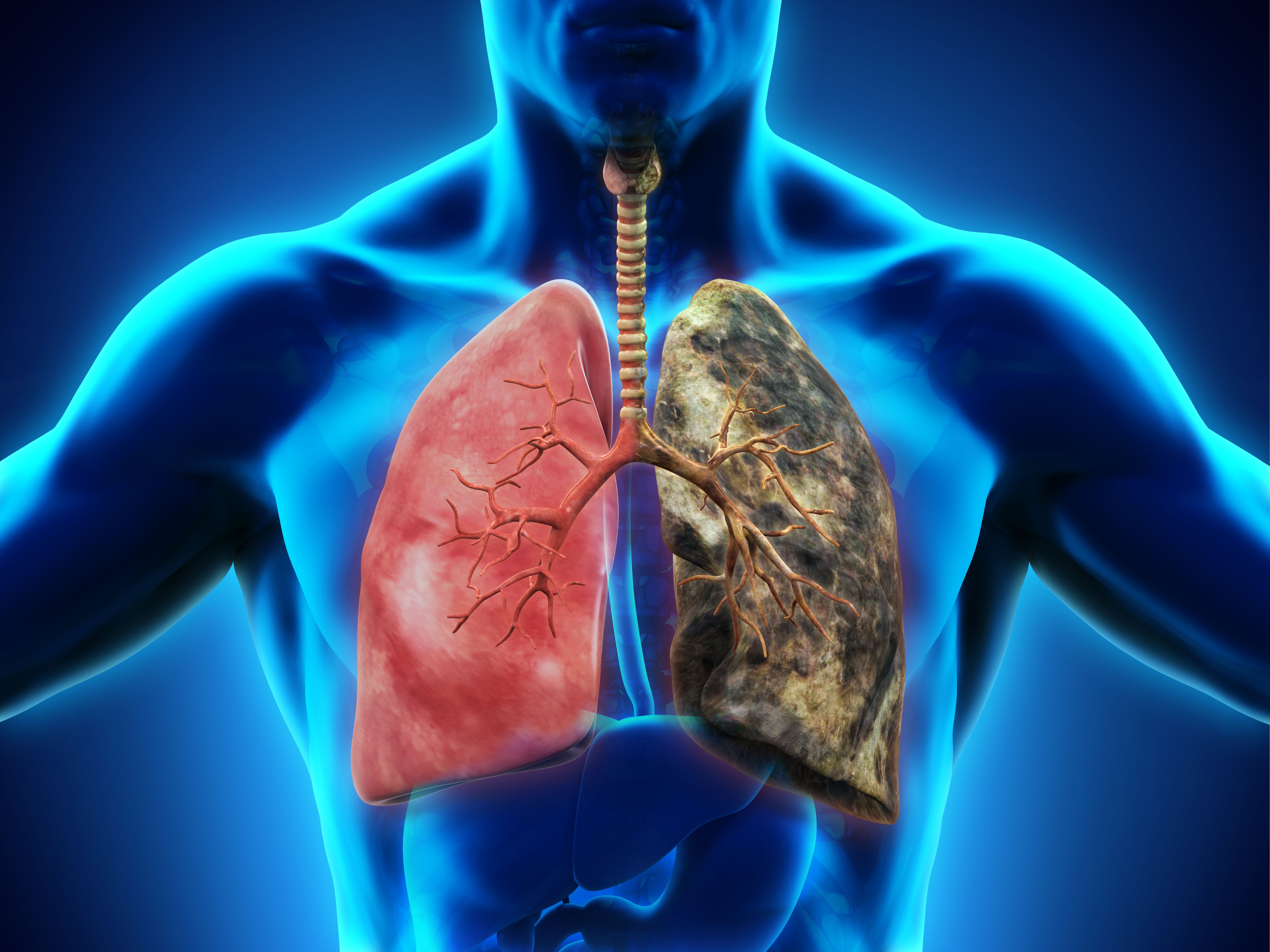 lung cancer pictures images