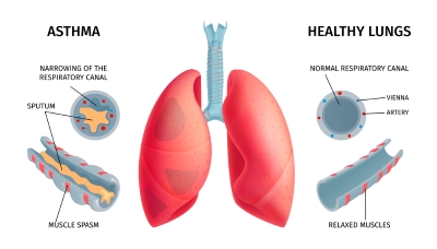 Asthma Alert 2022: Spring Time Asthma Conditions Are On The Way.