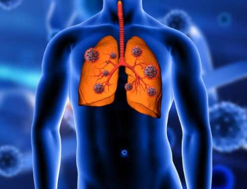 Lifestyle Adjustments for Managing Stage 4 Small Cell Lung Cancer