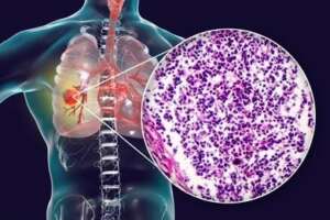 small lung cancer treatment