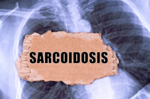 what is the best treatment for cardiac sarcoidosis