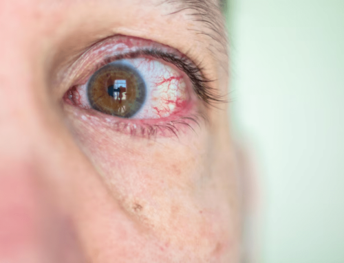 How to Tell If It’s Eye Allergy or Sarcoidosis—Key Differences
