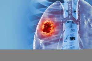 Non-Small Cell Lung Cancer