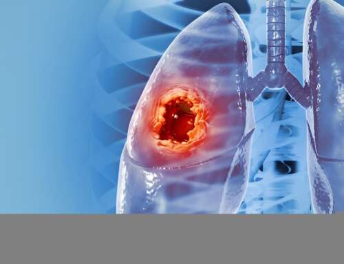 How Non-Small Cell Lung Cancer Affects Your Daily Life: A Specialist’s View?