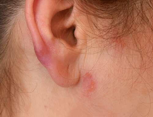 Understanding Cardiac Sarcoidosis: Signs and Treatment Advances