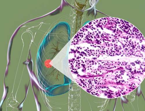Do’s and Don’ts of Small Cell Lung Cancer Treatment: Expert Tips
