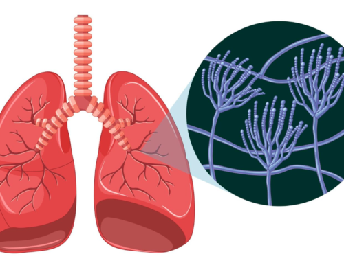 What Are Lung Nodules? Causes, Symptoms, and When to Worry