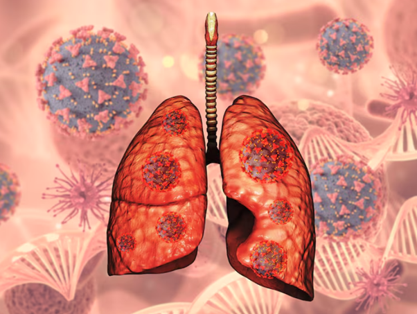 small cell lung cancer